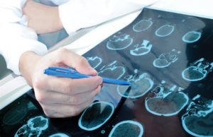 New breakthrough offers hope for potential treatment of rare childhood epilepsy