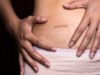 Patient satisfaction and quality of life similar across all appendicitis treatments