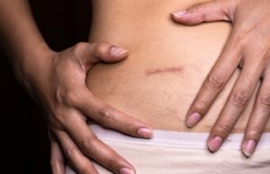 Patient satisfaction and quality of life similar across all appendicitis treatments