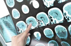 UTHealth physician-scientist receives AHA’s $1 million Merit Award for stroke research